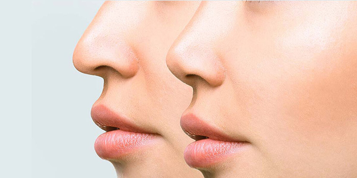 کوچک کردن بینی