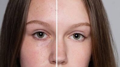 روش های طبیعی و خانگی برای درمان قطعی کک و مک | درمان کک و مک با ماسک های گیاهی 
