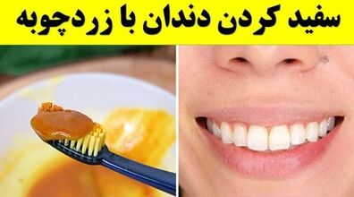 با زردچوبه مسواک بزن! | روش سفید کردن دندان با زردچوبه 