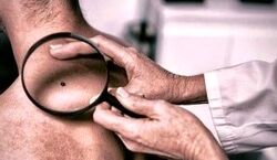 کدوم رنگ خال روی بدن نشانه خطر است؟ | نکاتی در مورد خال روی پوست که باید بدانید