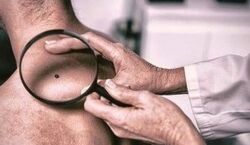کدوم رنگ خال روی بدن نشانه خطر است؟ | نکاتی در مورد خال روی پوست که باید بدانید