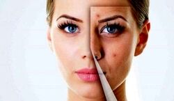 اگه جای جوش و لک داری حتما ببین! | پاکسازی صورت با روش های خانگی + فیلم
