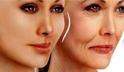 روش های از بین بردن چروک صورت و اصلاح خط لبخند