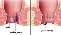 بواسیر یا هموروئید رو با این روش ها درمان کن! | راهکارهای خانگی برای درمان بواسیر