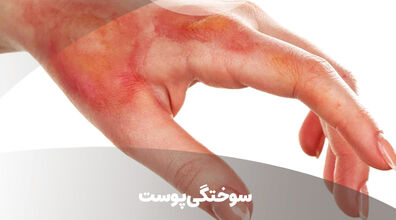 اگه سوختگی رو اینجوری درمان کنی دیگه جاش نمیمونه!