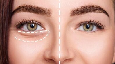 اول صبح چشام پف می کنه، چیکار کنم؟ | علت و ترفندهای خانگی رفع پف چشم