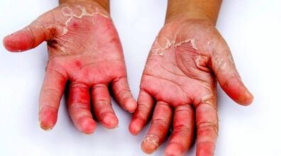 چرا دستم پوست پوست میشه؟ + روش درمان 